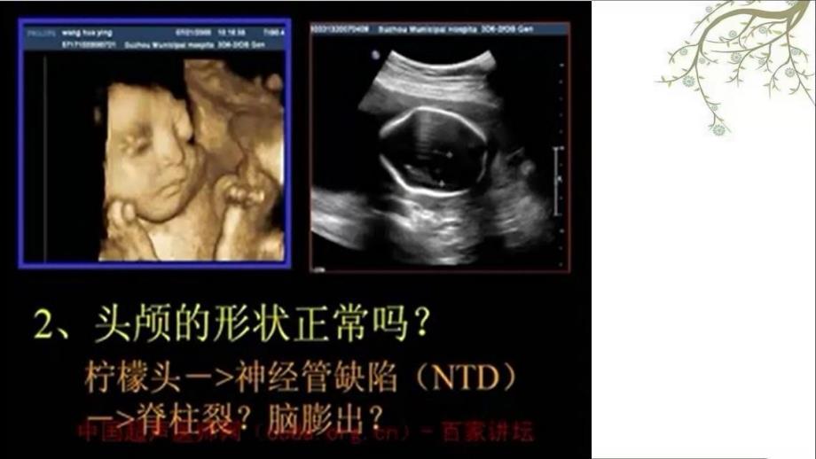 胎儿中枢神经系统检查思路课件_第4页