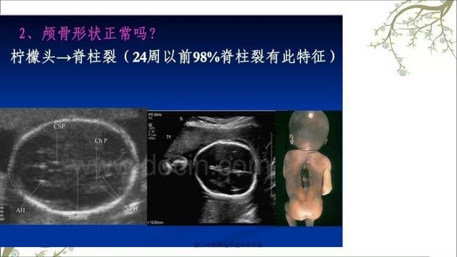 胎儿中枢神经系统检查思路课件_第5页