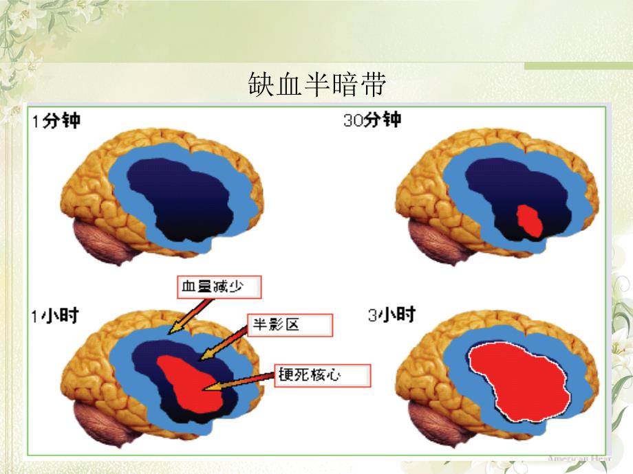 急性脑梗死静脉溶栓 PPT课件.ppt_第2页