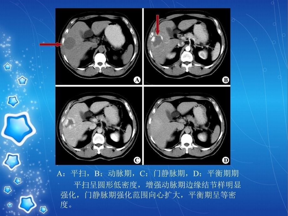 肝脏疾病的CT、MRI诊断)精品课件_第5页