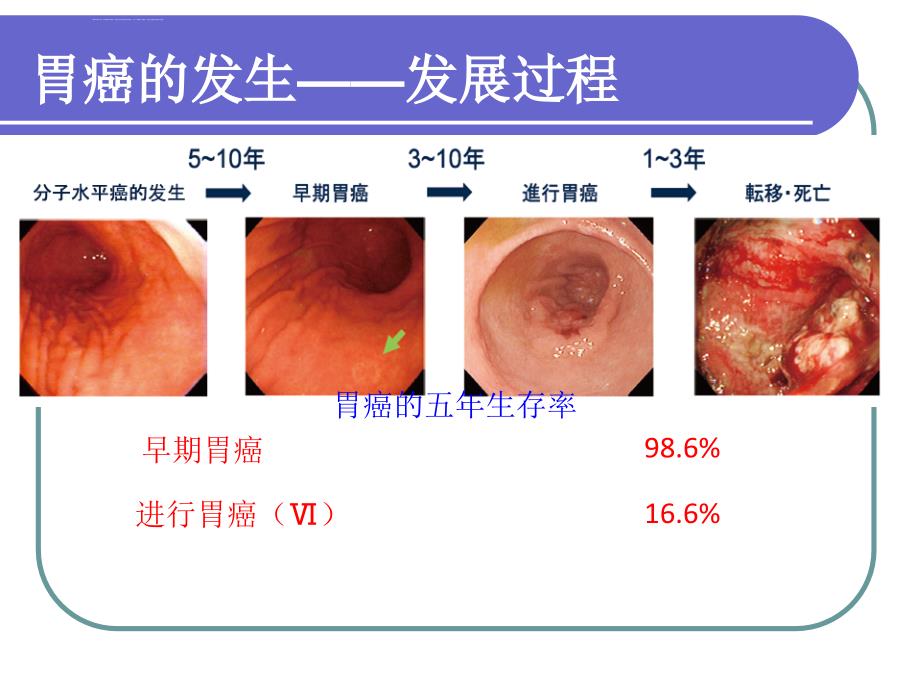 早期胃癌诊断的一点体会ppt课件_第3页