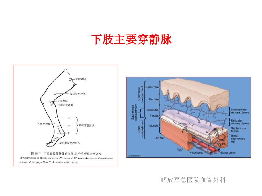 浅谈下肢静脉曲张及其治疗策略课件_第4页