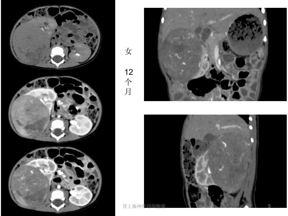 肾上腺神经母细胞瘤课件_第5页