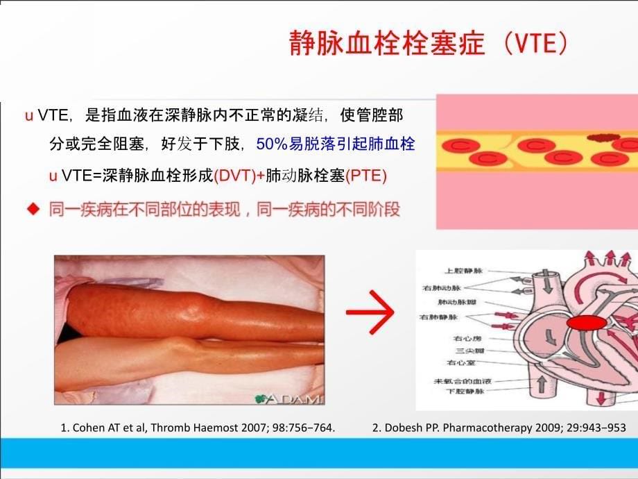 VTE综合防控及标准预防课件_第5页