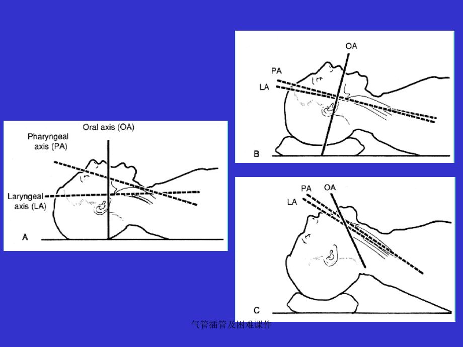 气管插管及困难课件_第3页