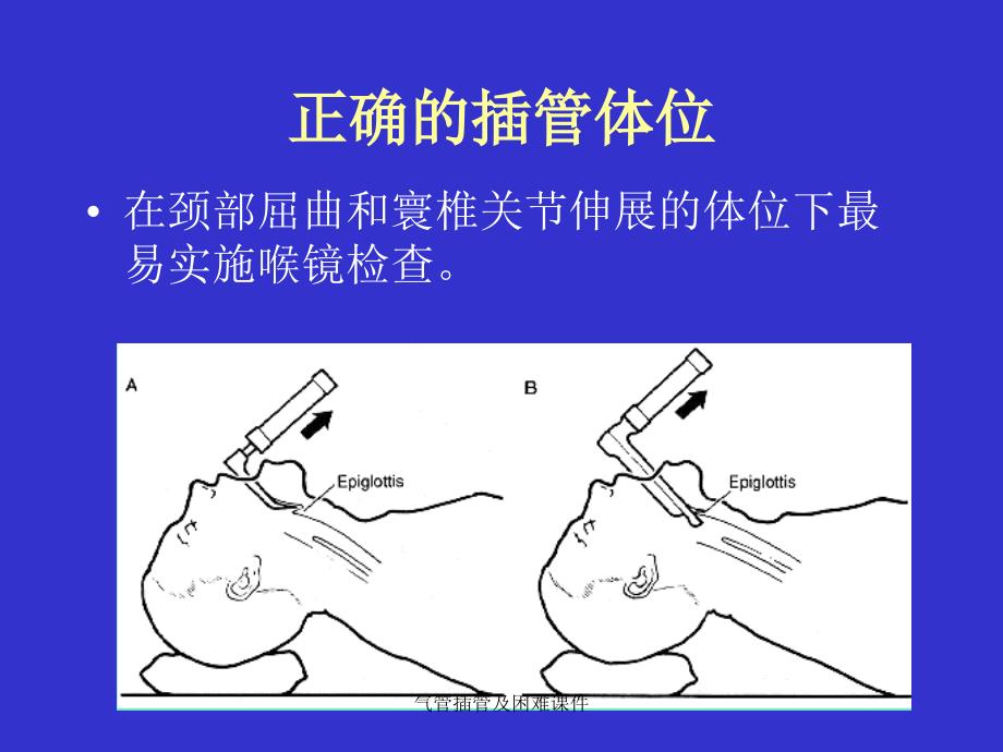 气管插管及困难课件_第4页