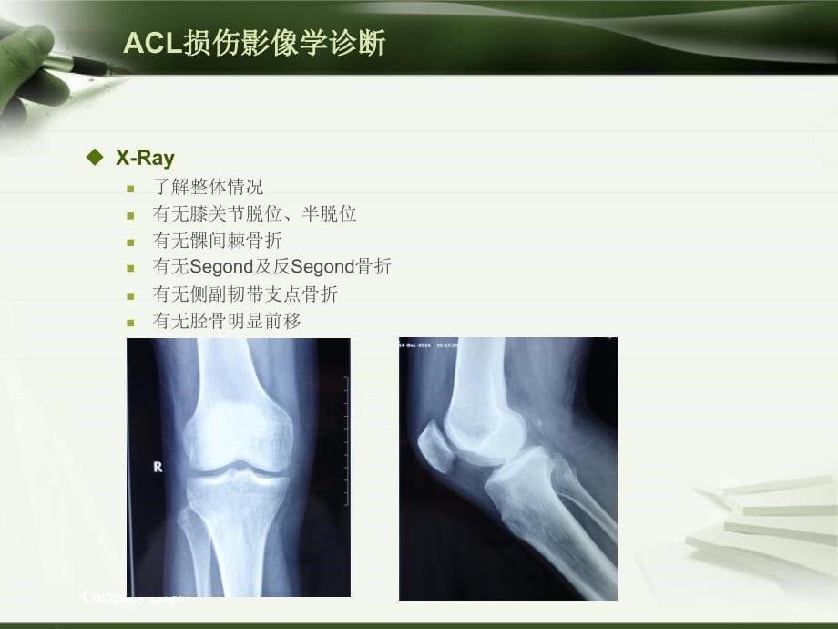 ACL损伤影像学诊断教程_第5页