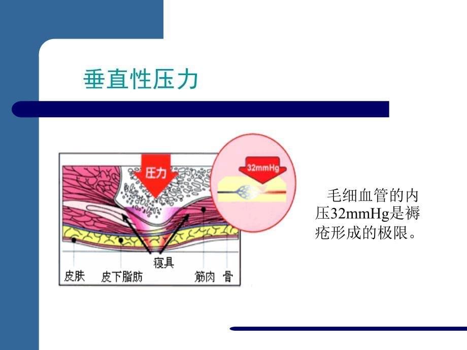 【医学】压疮的预防与护理_第5页