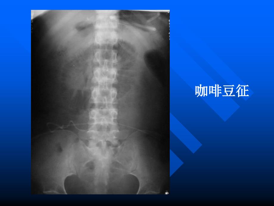 腹膜腔与腹膜后间隙影像学_第4页