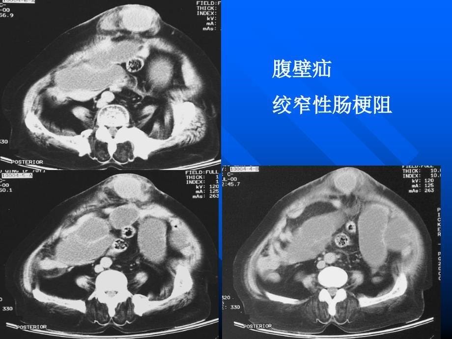 腹膜腔与腹膜后间隙影像学_第5页