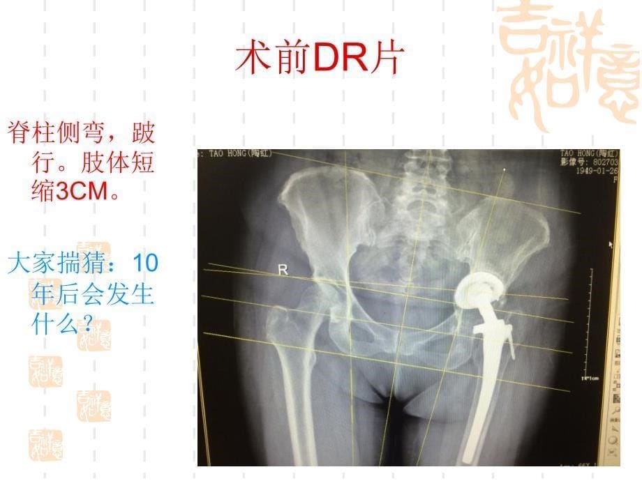 髋关节二次翻修及膝关节置换_第5页