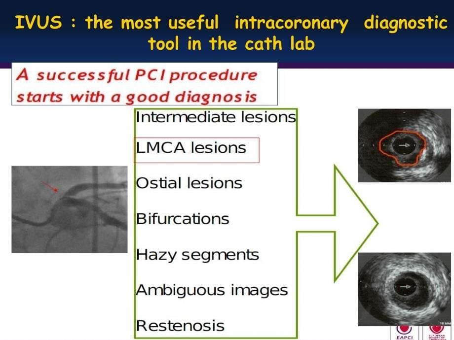 ivus在lm介入治疗中的应用课件幻灯_第5页