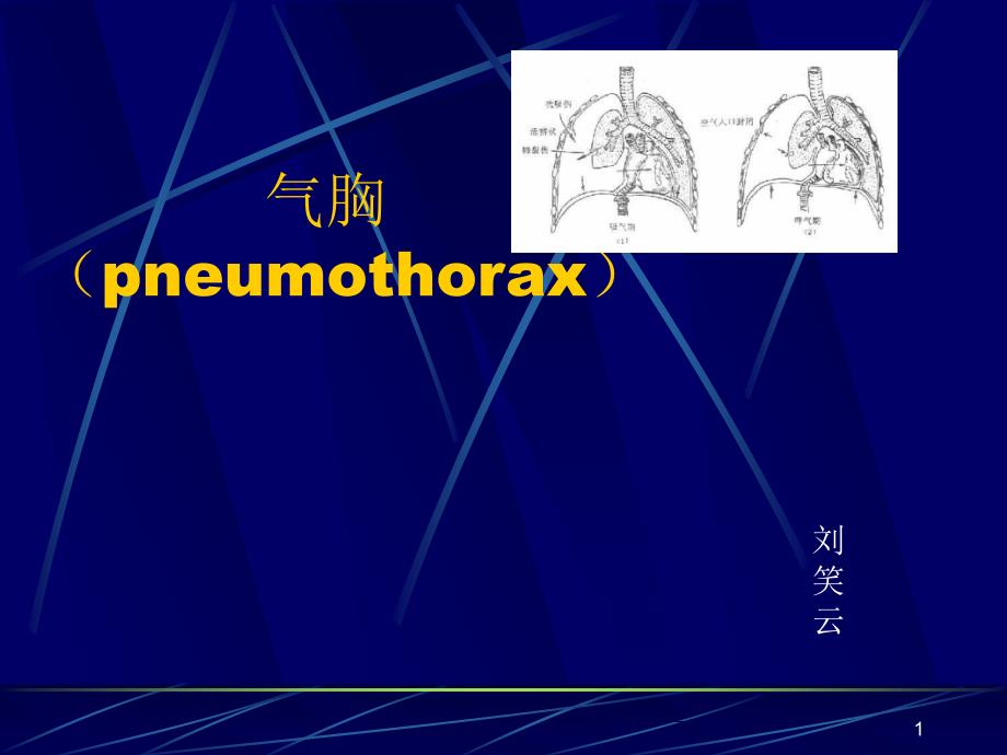 气胸PPT课件_第1页