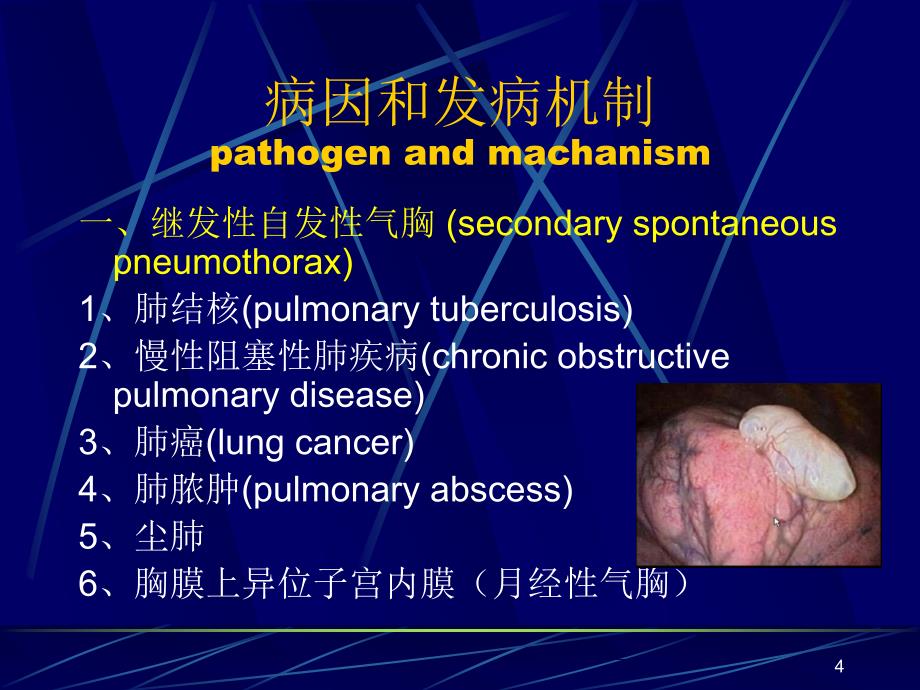 气胸PPT课件_第4页