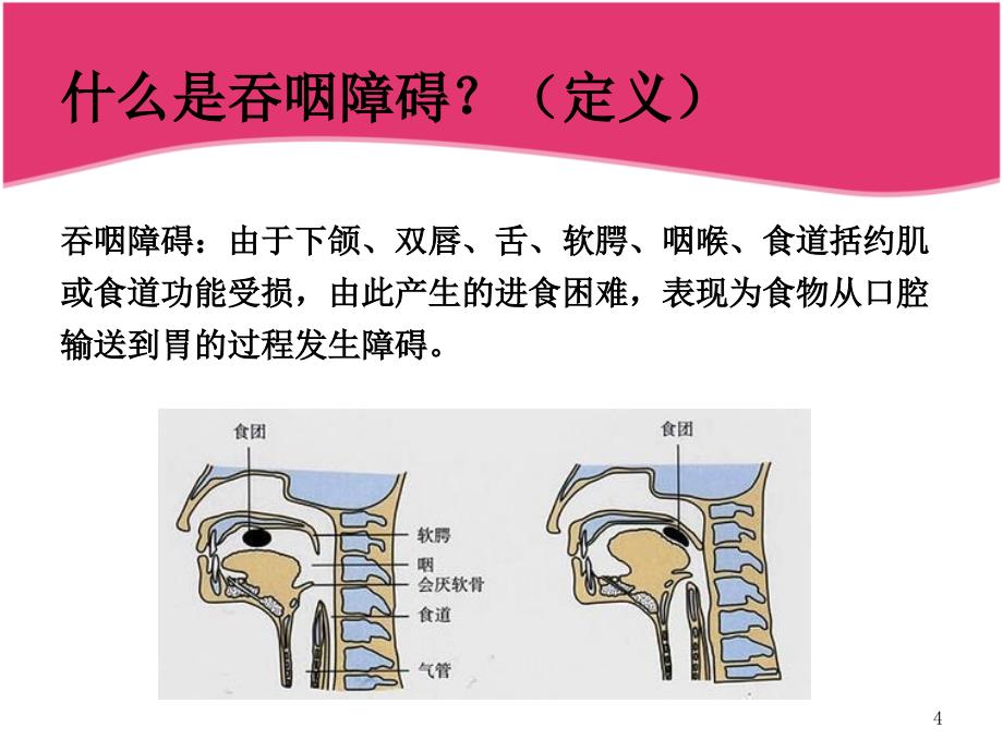 吞咽障碍课件_第4页