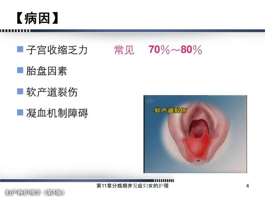 第11章分娩期并发症妇女的护理课件_第4页