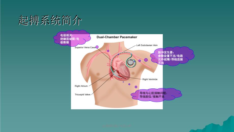 起搏器故障心电图分析课件_第2页