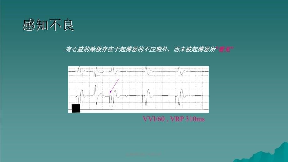 起搏器故障心电图分析课件_第5页