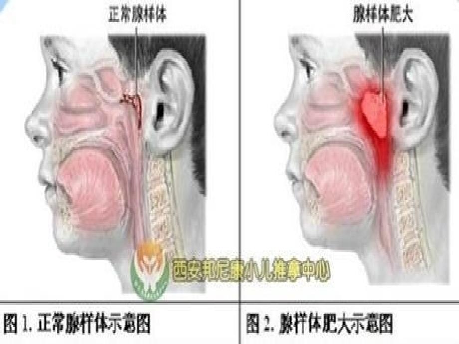 腺样体肥大手术患者的护理ppt课件_第3页