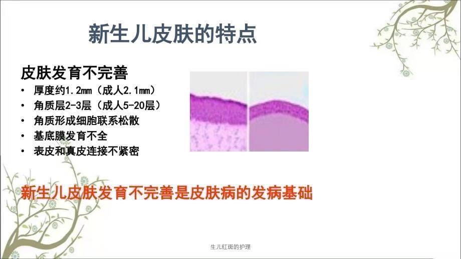 生儿红斑的护理课件_第5页