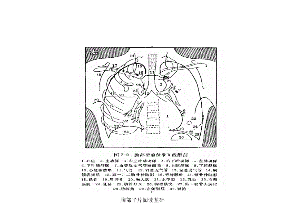 胸部平片阅读基础课件_第3页