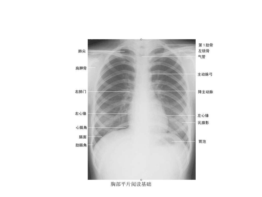 胸部平片阅读基础课件_第4页