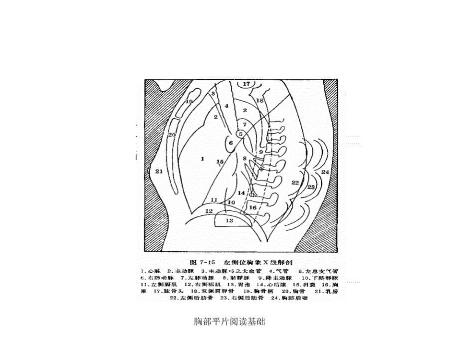 胸部平片阅读基础课件_第5页