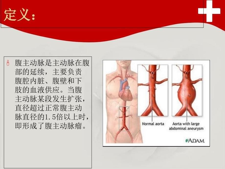 腹主动脉瘤的护理_第5页