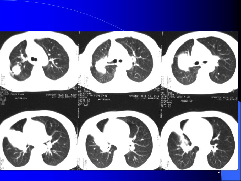 胸部CT阅片及诊断_第3页