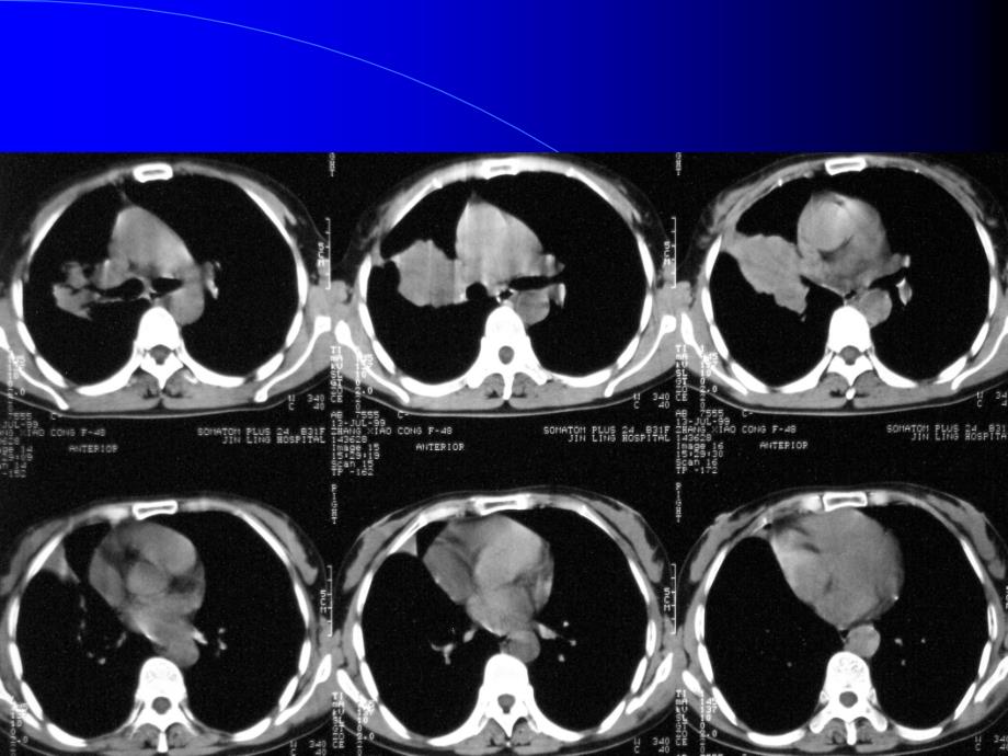 胸部CT阅片及诊断_第4页