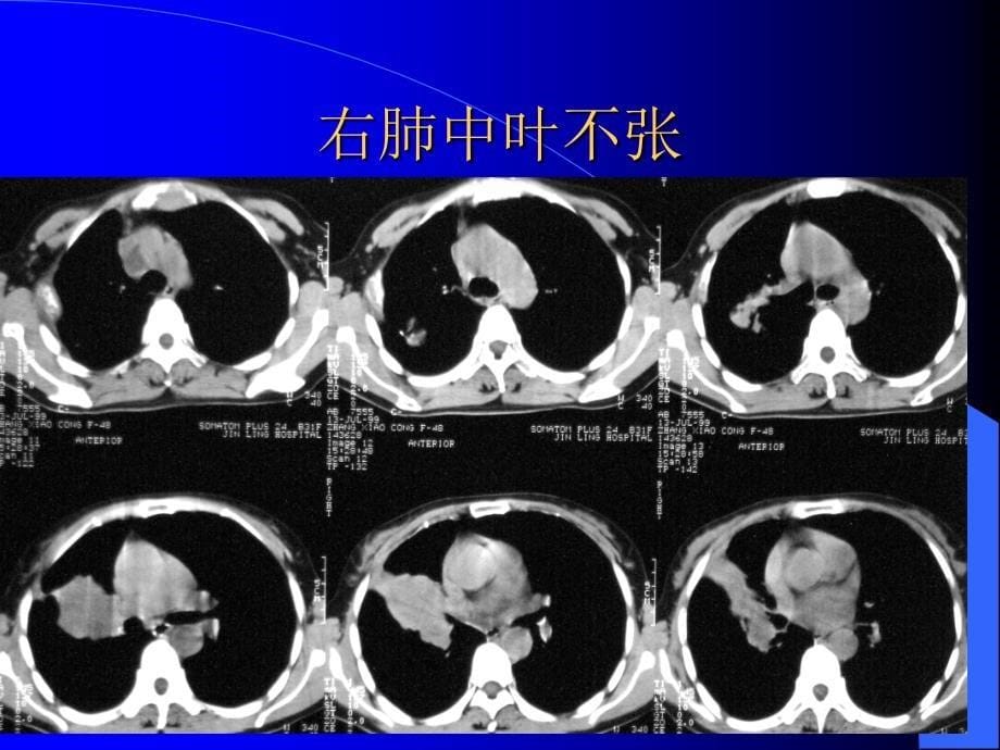 胸部CT阅片及诊断_第5页