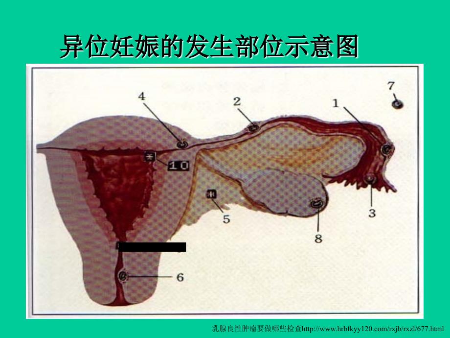 异位妊娠的病因和诊断方法_第3页