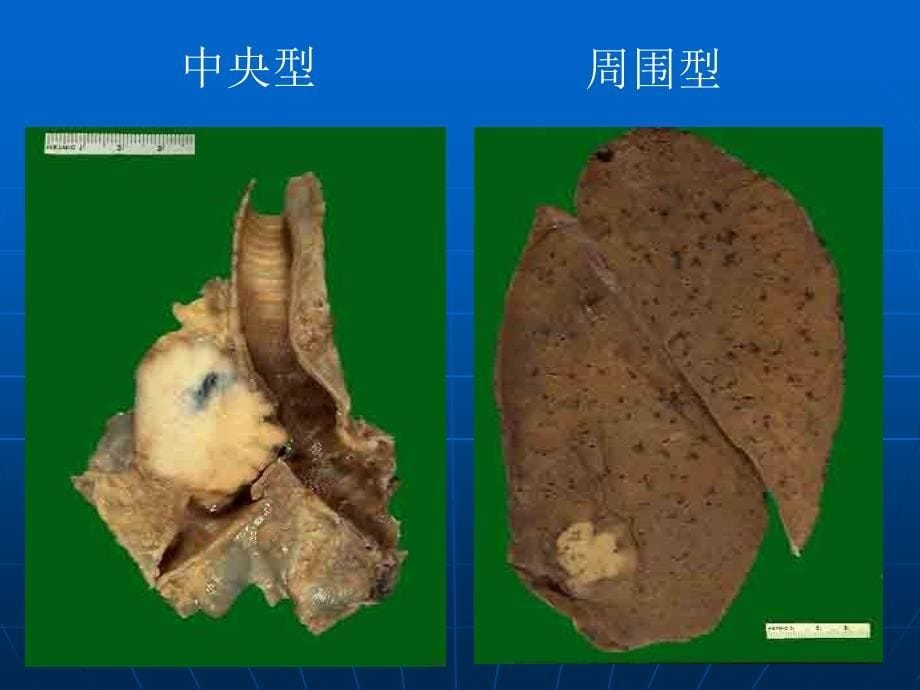 外科学教学资料胸部肿瘤_第5页