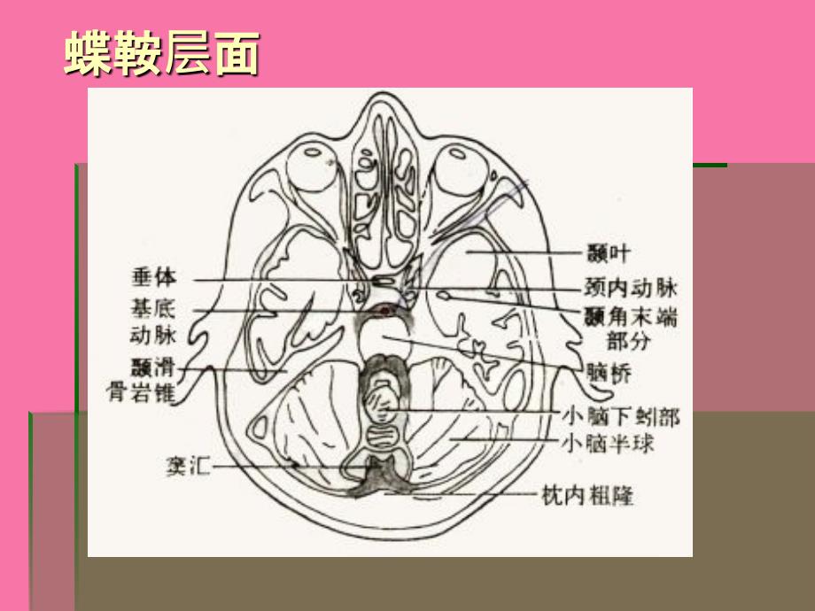 脑头颅CT示意PPT课件_第4页