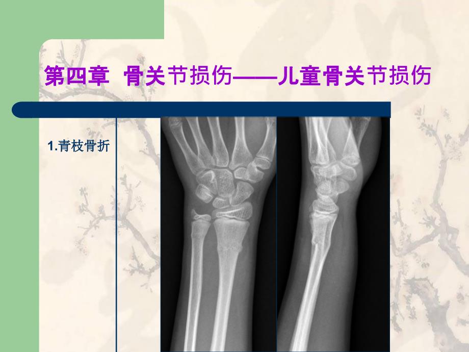 X线儿童骨关节损伤ppt课件_第3页