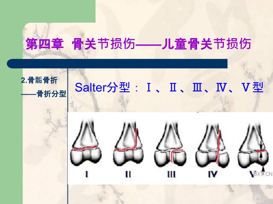 X线儿童骨关节损伤ppt课件_第4页