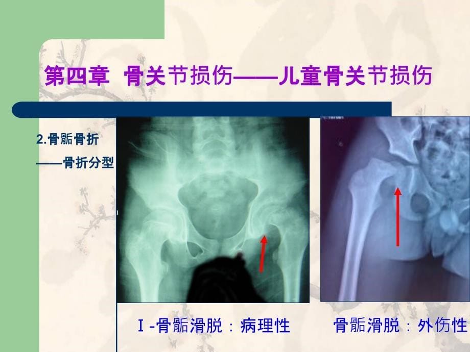 X线儿童骨关节损伤ppt课件_第5页