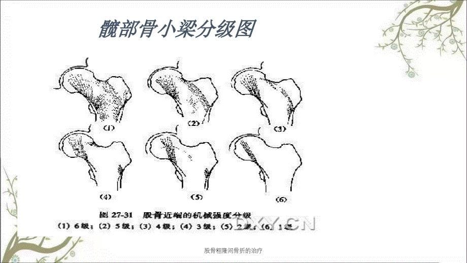 股骨粗隆间骨折的治疗课件_第5页