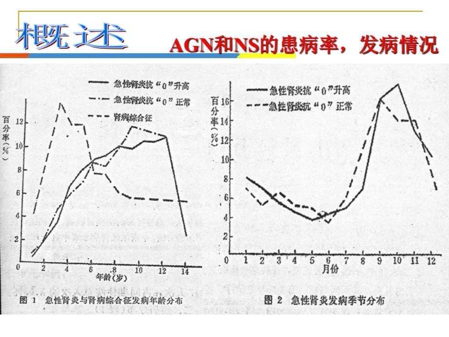 医学课件急性肾炎和肾病综合征PPT课件_第5页